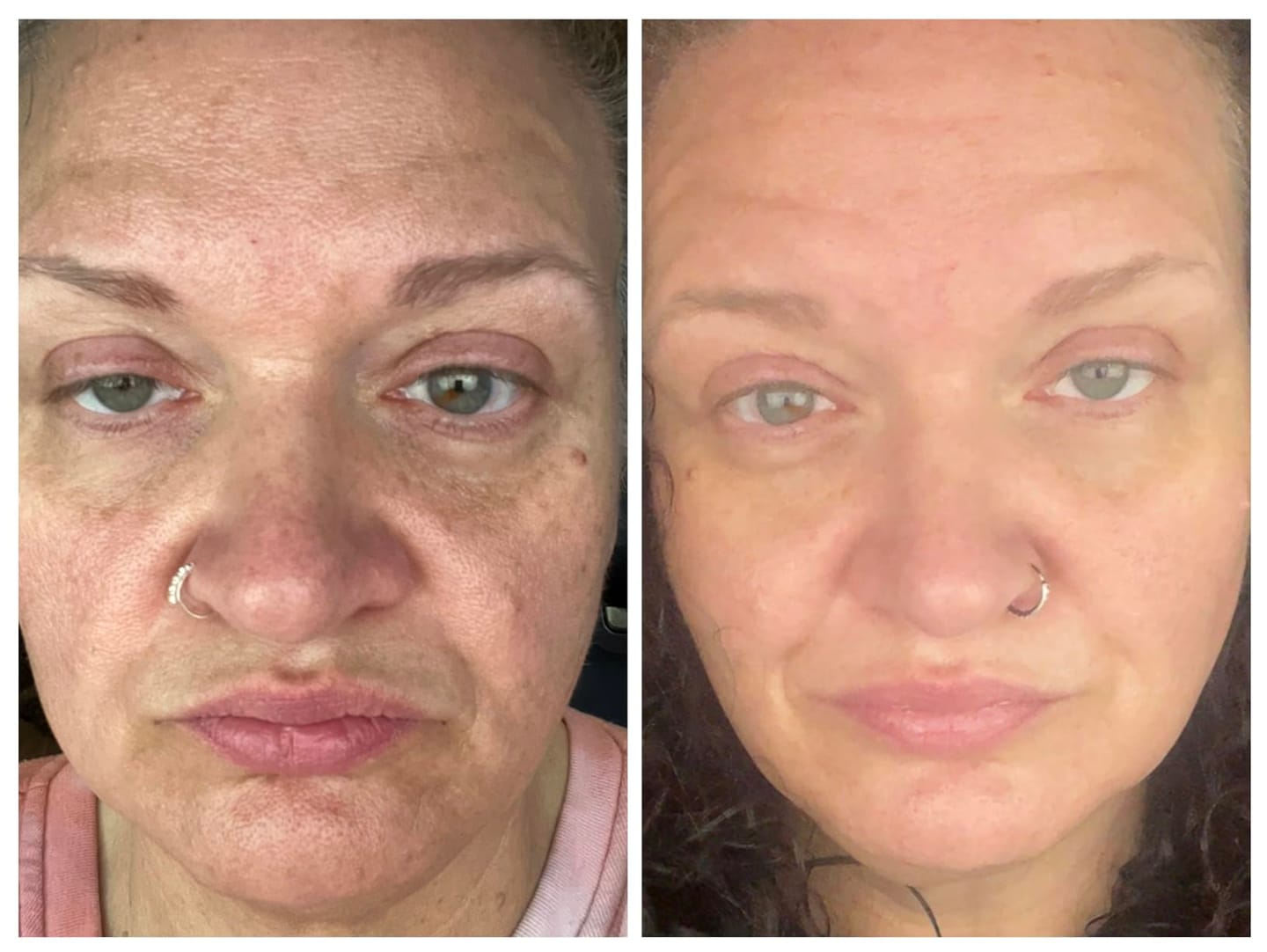 Customer photo review of Multi Collagen Complex for Women – 240 Capsules with Biotin