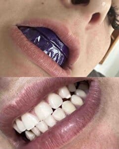 Customer photo review of VELAOUR - DİŞ BEYAZLATMA BANDI