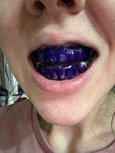 Customer photo review of VELAOUR - DİŞ BEYAZLATMA BANDI