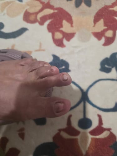 Customer's foot showing toe nails after using Lunavia Panel-Tratamiento para Hongos.