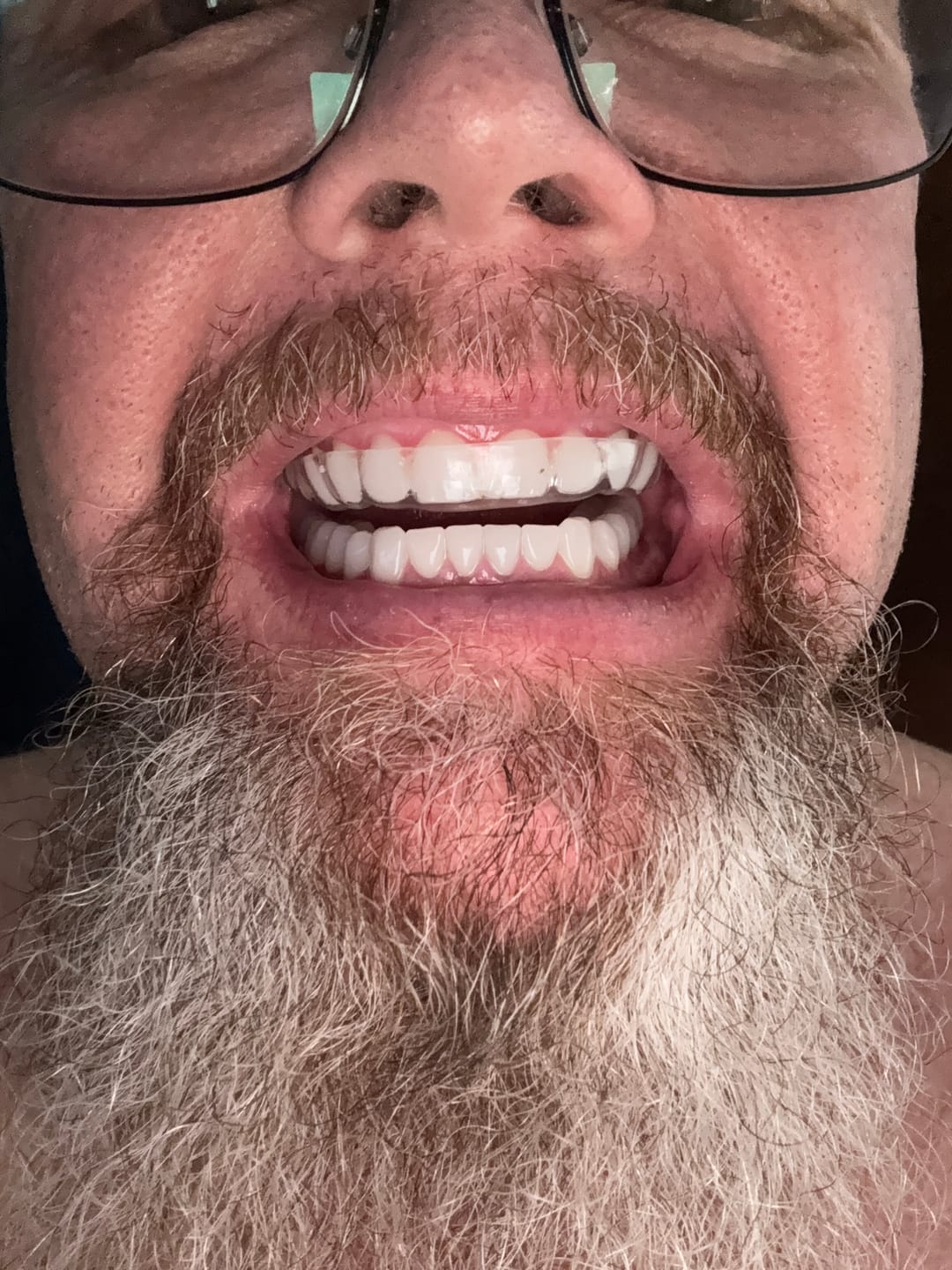 Customer photo review of Clear Custom Night Guard