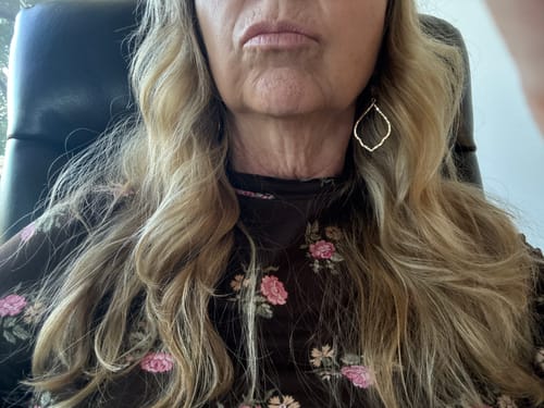 Reviewer showing face and neck skin after 4 treatments with The Micro Infusion System.