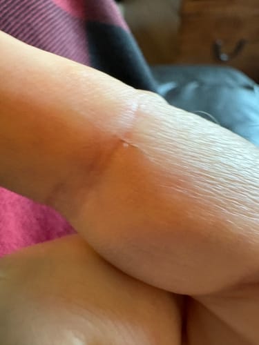 Customer's finger showing a small cut, purportedly caused by the Attractify Auto Utility Tool