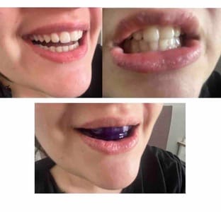 Customer photo review of VELAOUR - DİŞ BEYAZLATMA BANDI