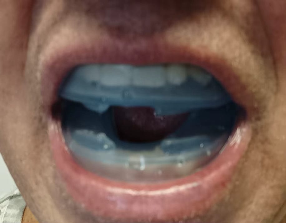 Customer photo review of Orthèse Anti-Ronflement Vantyx™