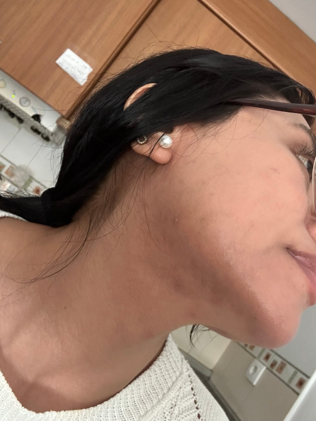 Customer photo review of A CONTROL - ACNÉ HORMONAL & RESISTENCIA A LA INSULINA