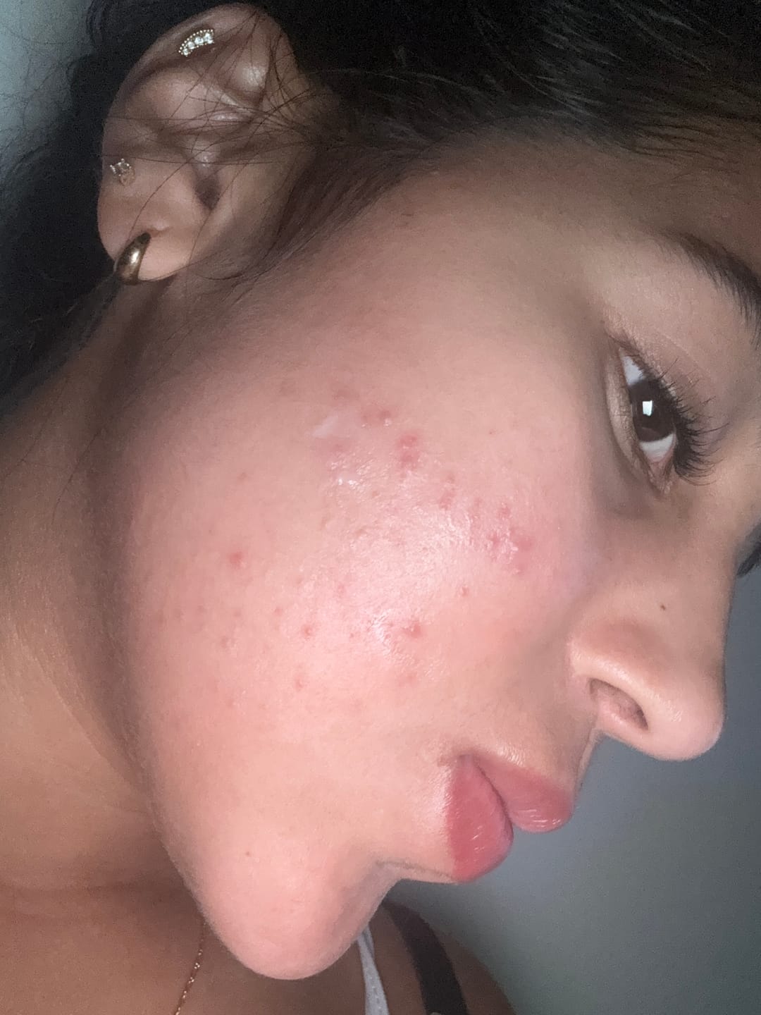 Customer photo review of A CONTROL - ACNÉ HORMONAL & RESISTENCIA A LA INSULINA