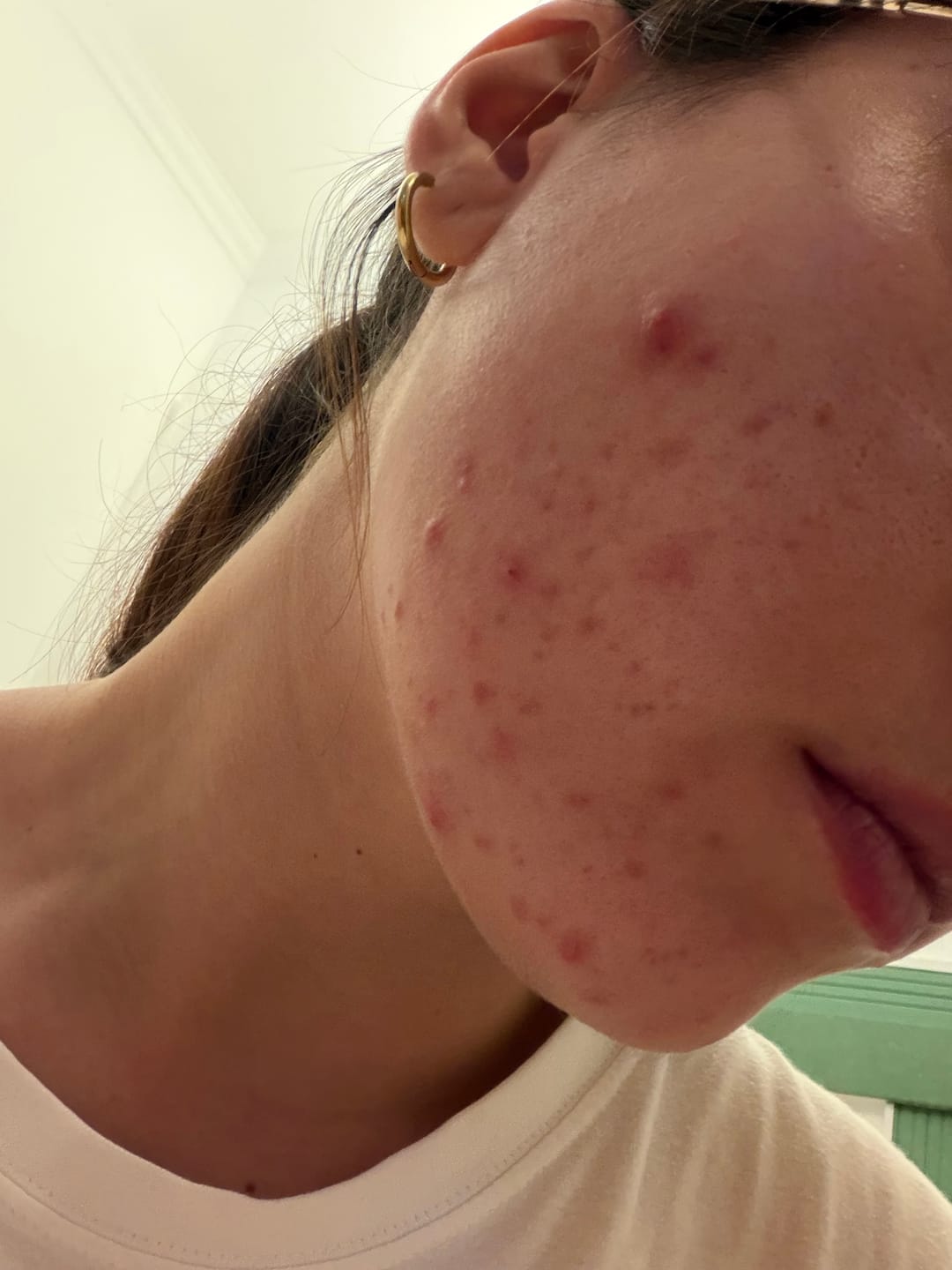 Customer photo review of A CONTROL - ACNÉ HORMONAL & RESISTENCIA A LA INSULINA