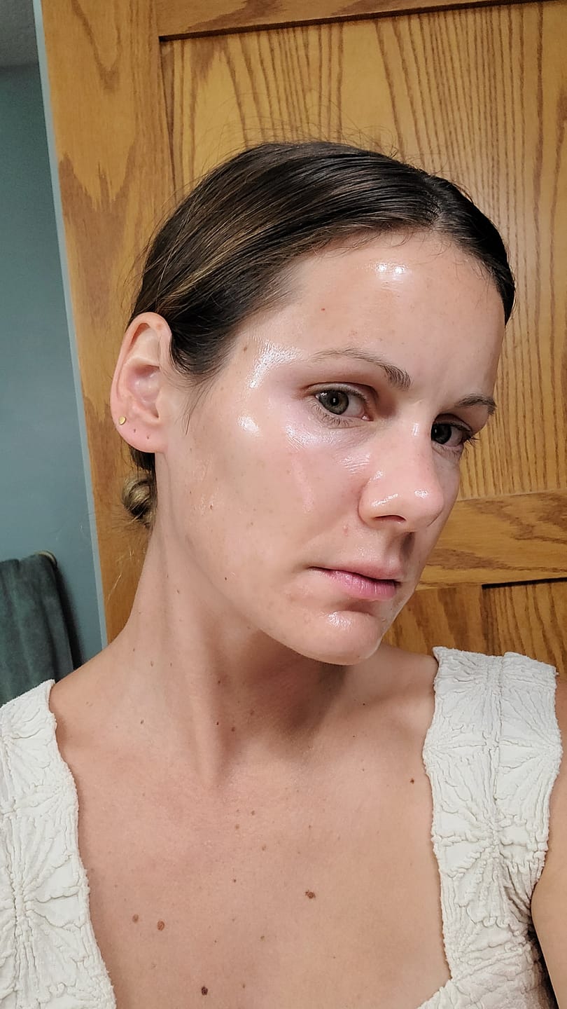 Customer photo review of BeautyPro 2.0 - High Frequency Wand