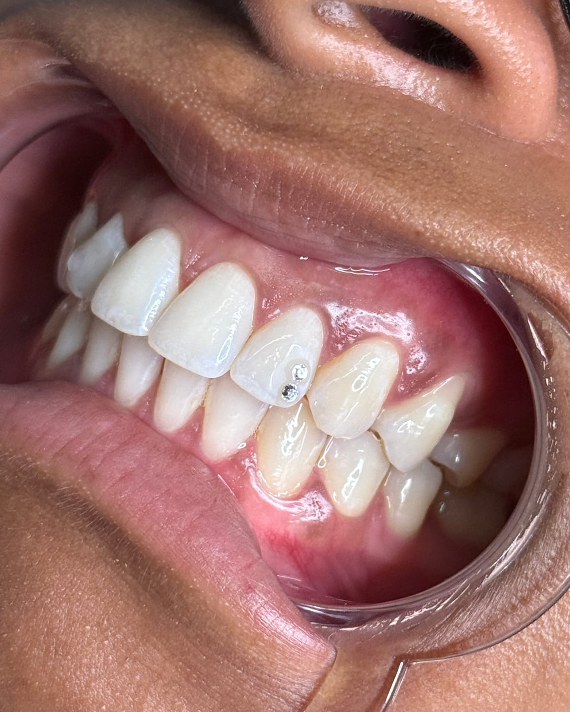 Customer photo review of Crystal Clear 1.8mm Swarovski® Tooth Gem Crystals – 5-pack