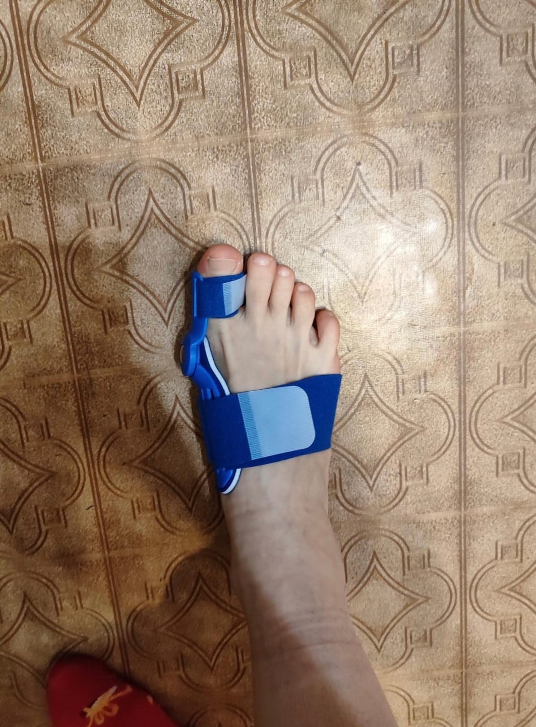 Customer photo review of MYOFILL Align