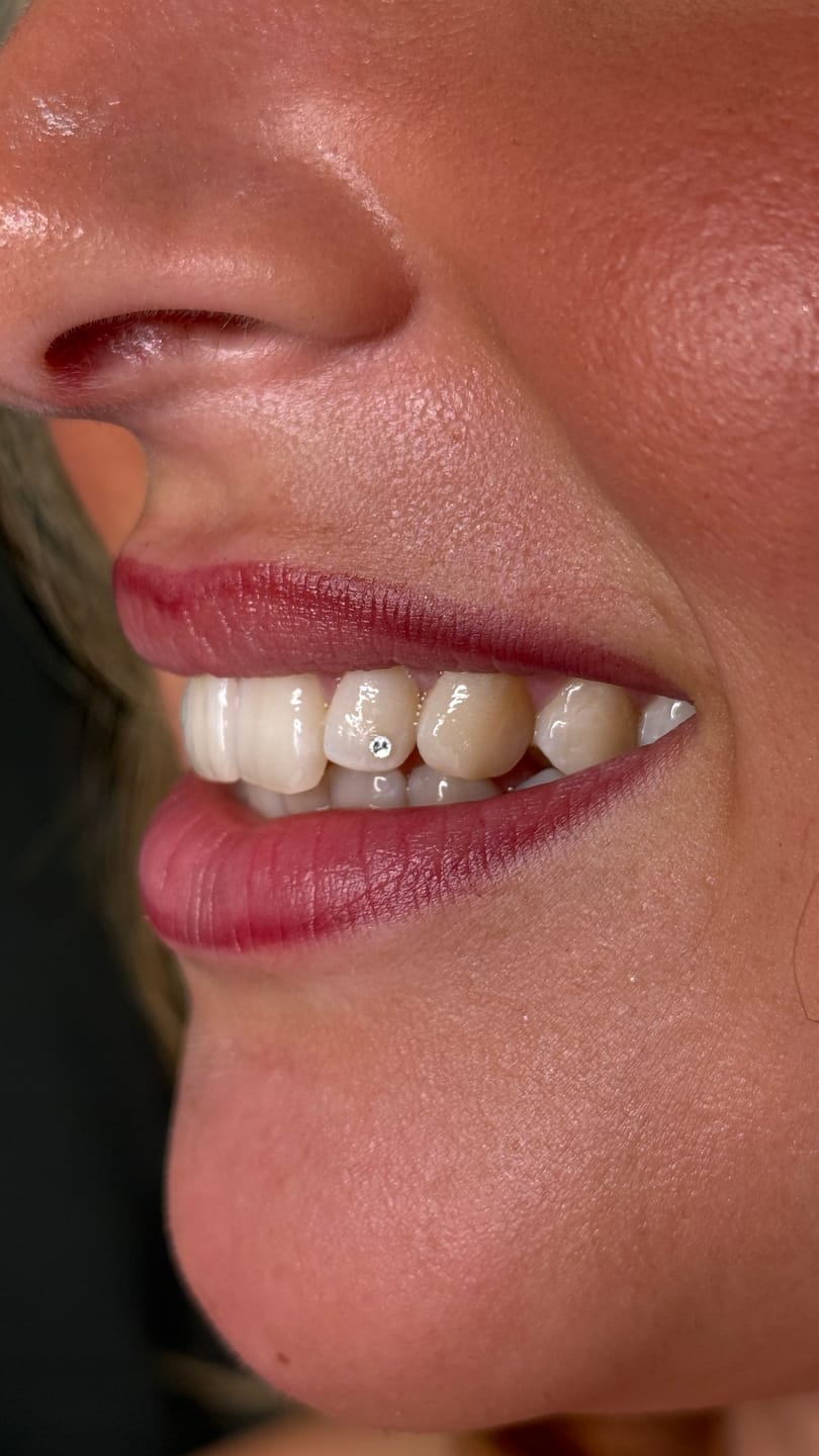 Customer photo review of Crystal Clear 1.8mm Swarovski® Tooth Gem Crystals – 5-pack