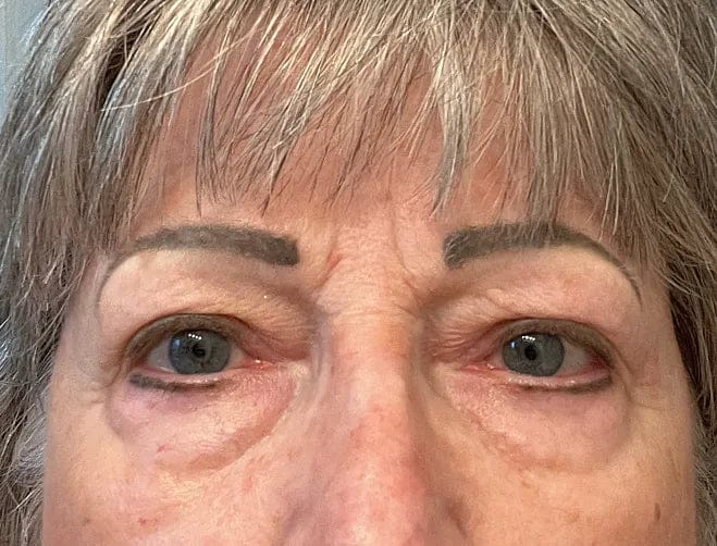 Customer photo review of NoaPure Instant Eye Lift Gel | Göz Çevresi Bakım Jeli