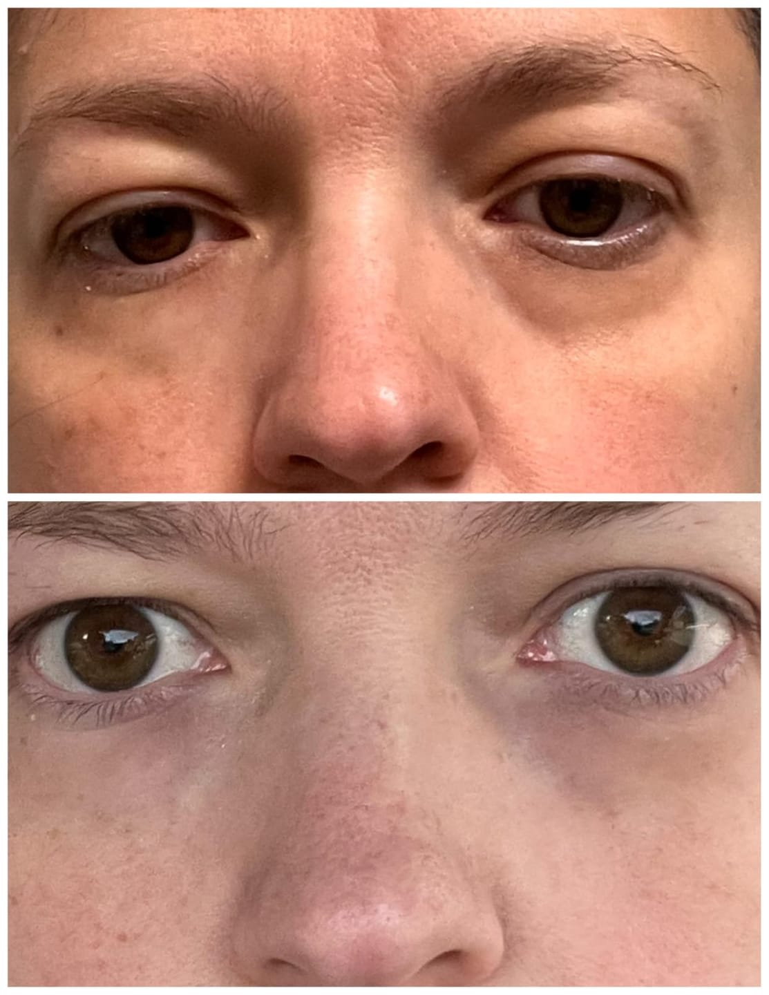 Customer photo review of NoaPure Instant Eye Lift Gel | Göz Çevresi Bakım Jeli