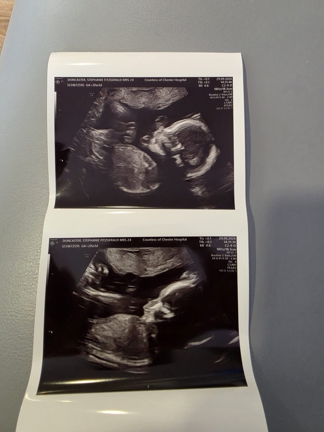 Customer photo review of Liposomal Pregnancy Support Formula