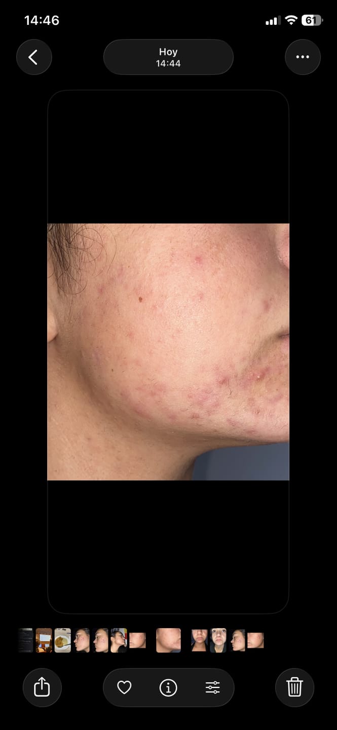 Customer photo review of A CONTROL - ACNÉ HORMONAL & RESISTENCIA A LA INSULINA
