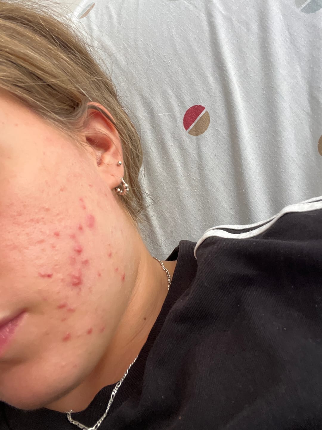 Customer photo review of A CONTROL - ACNÉ HORMONAL & RESISTENCIA A LA INSULINA