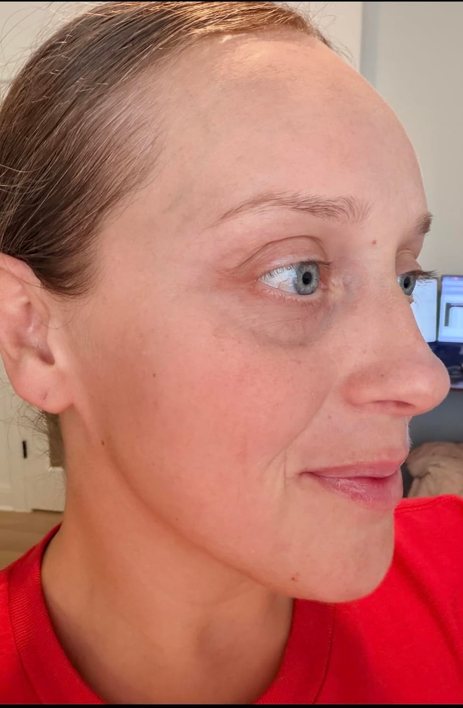 Customer photo review of NoaPure Instant Eye Lift Gel | Göz Çevresi Bakım Jeli