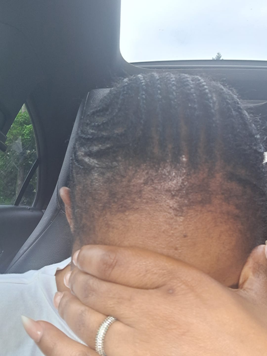 Customer photo review of Scalp Serum Set - Minoxidil