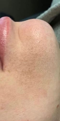 Customer photo review of Voise IPL hair removal device US