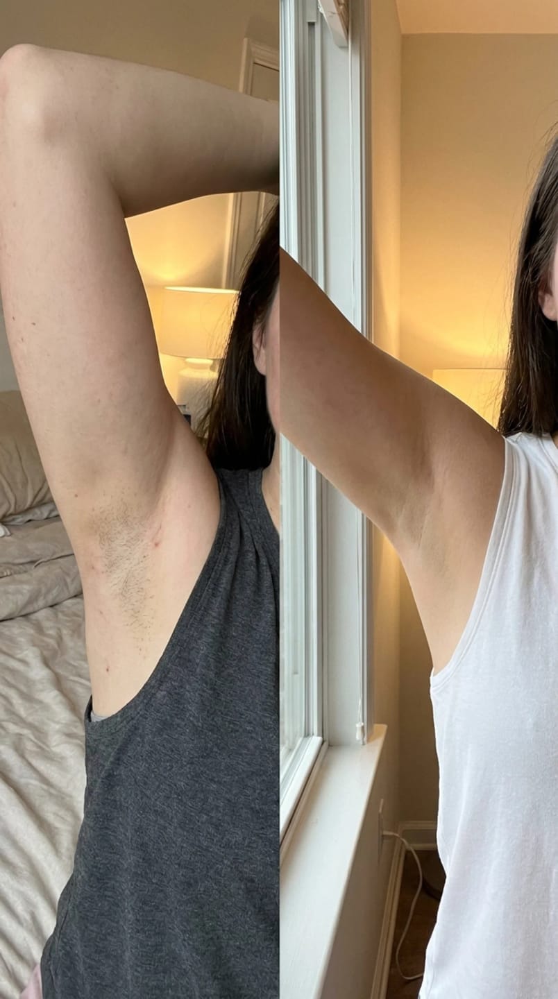 Customer photo review of Voise IPL hair removal device DE