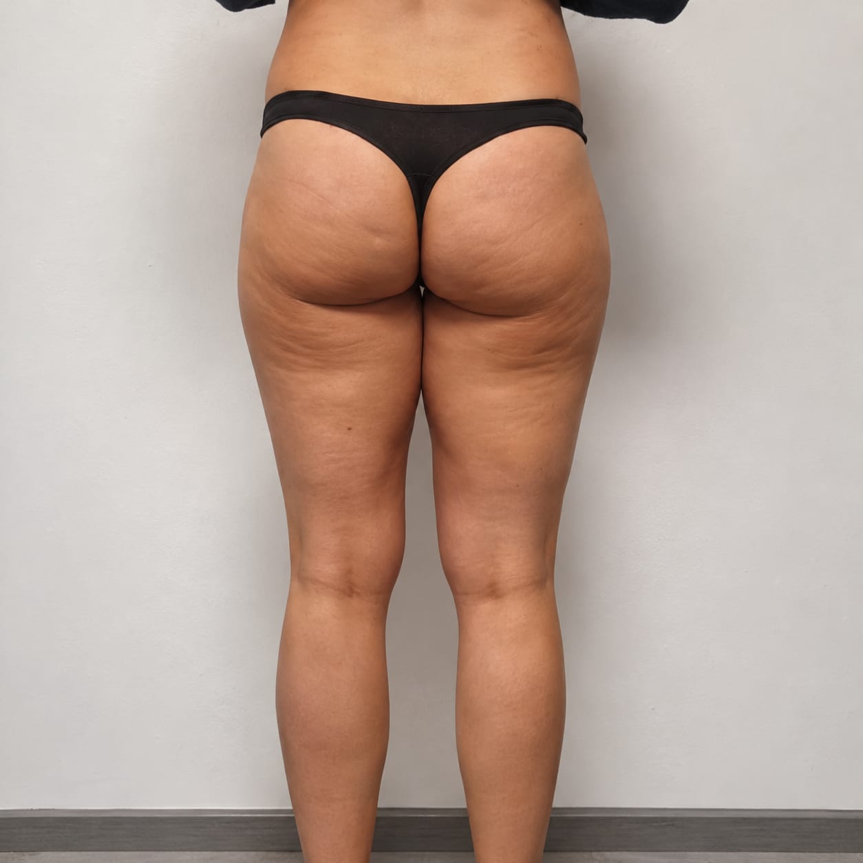Customer photo review of 3D Anti Cellulite Kompressionsleggings