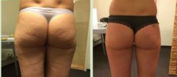 Customer photo review of 3D Anti Cellulite Kompressionsleggings