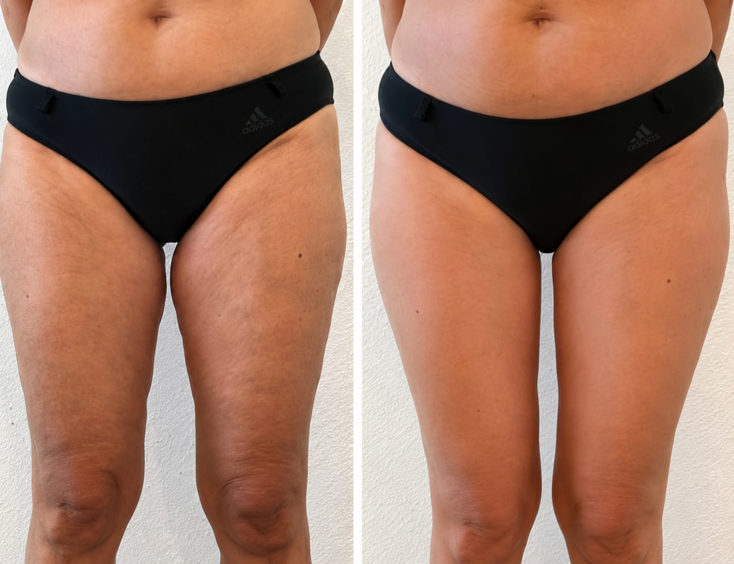 Customer photo review of 3D Anti Cellulite Kompressionsleggings