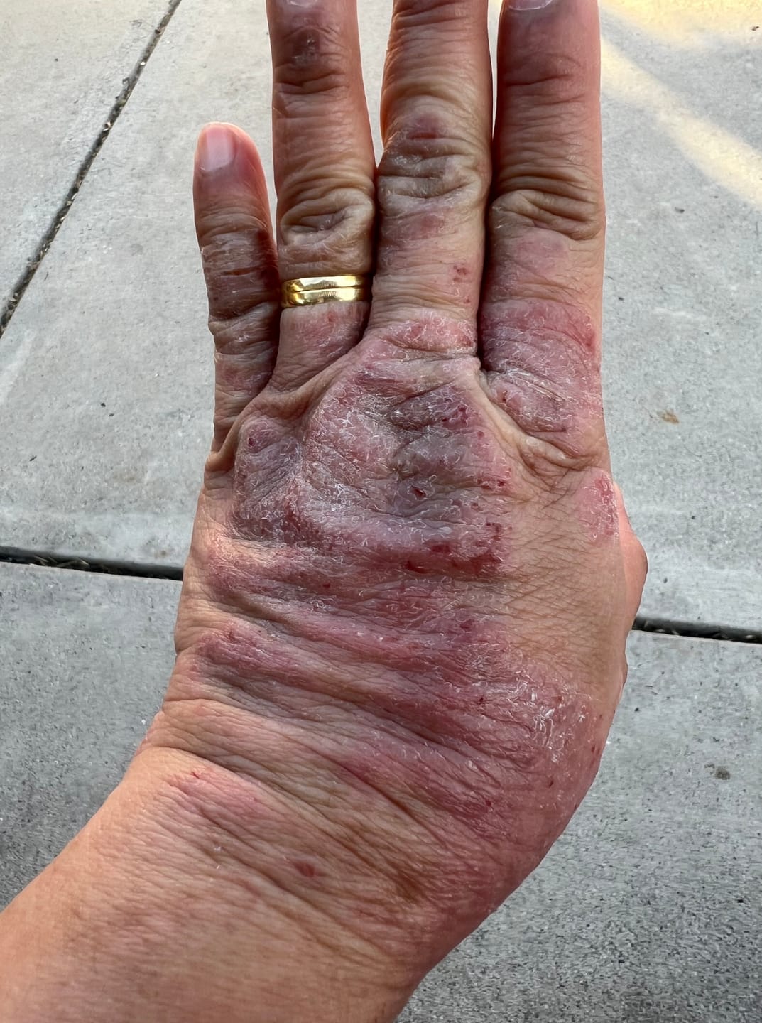 Customer photo review of Smiles & Joys Eczema and Psoriasis Herbal Cream