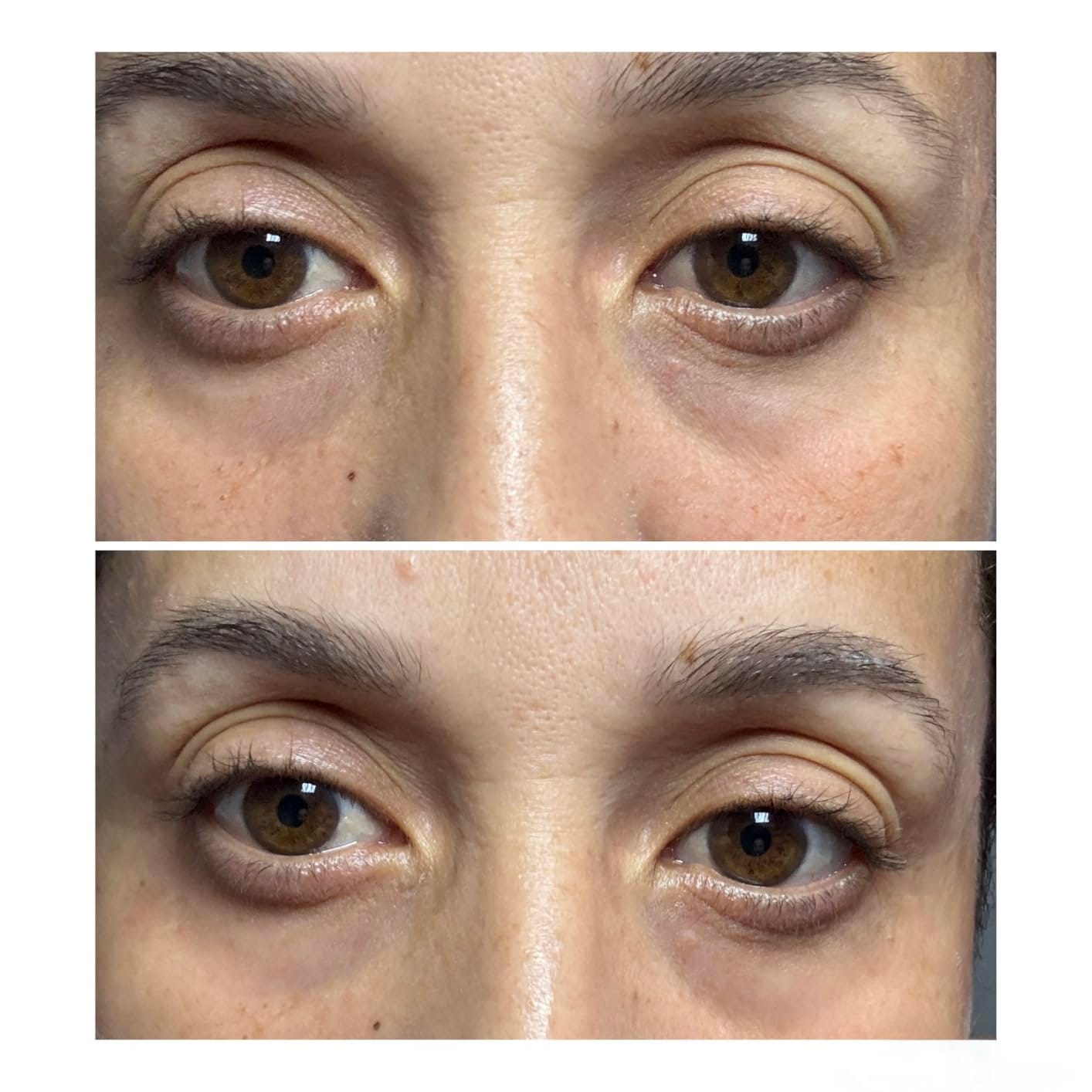 Customer photo review of NoaPure Instant Eye Lift Gel | Göz Çevresi Bakım Jeli