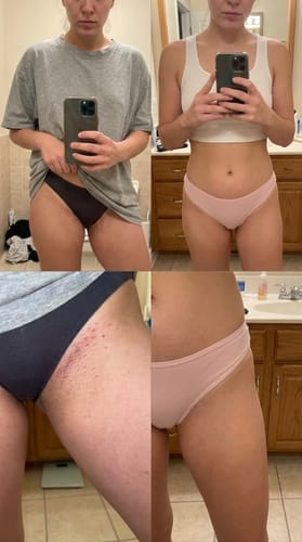 Customer photo review of Voise IPL hair removal device US