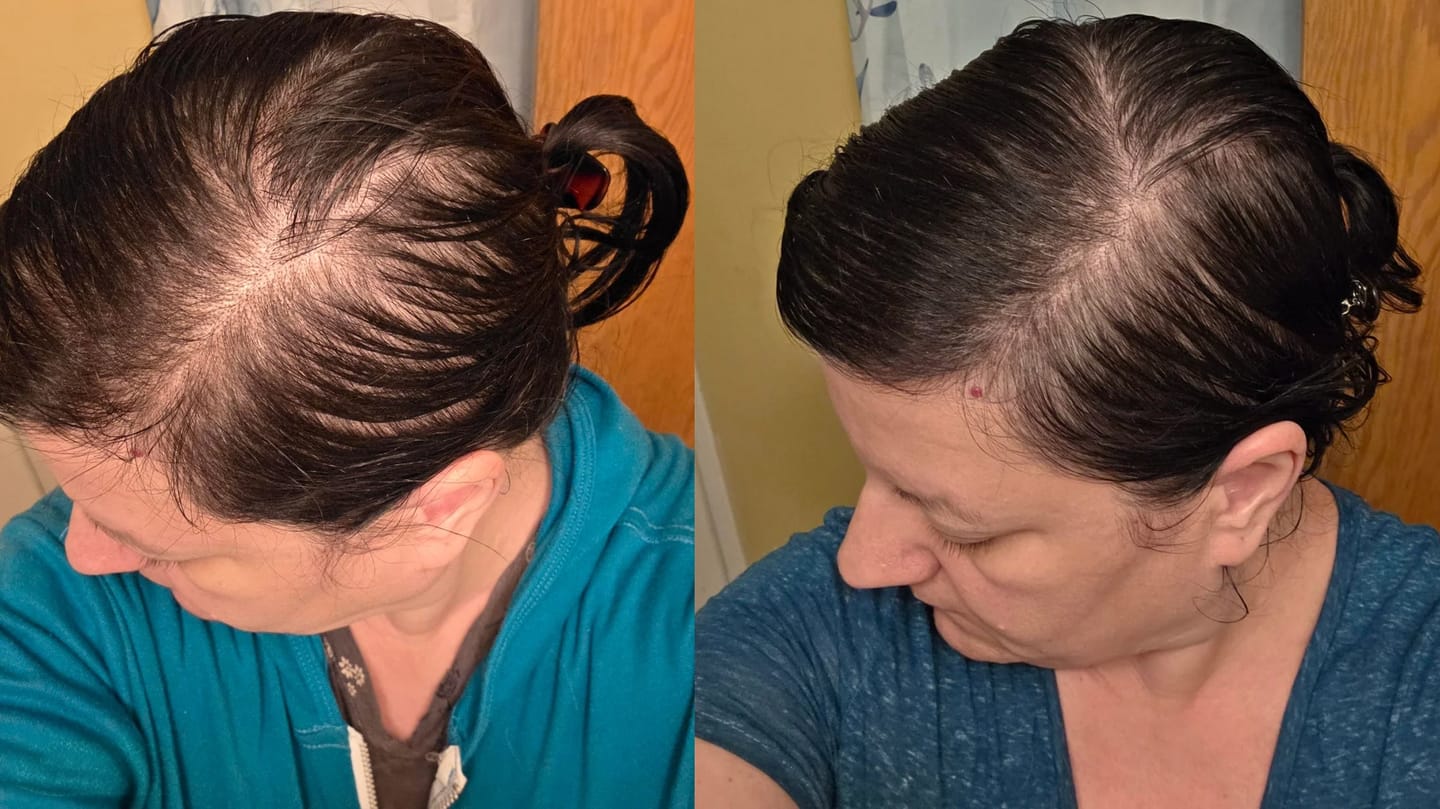 Customer photo review of Serum Anticaída para hombres y mujeres Hair Biolabs™
