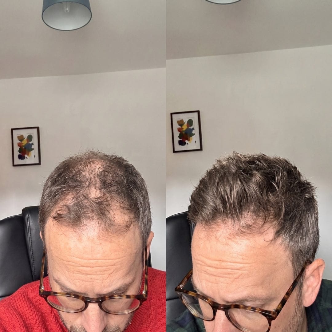 Customer photo review of Serum Anticaída para hombres y mujeres Hair Biolabs™