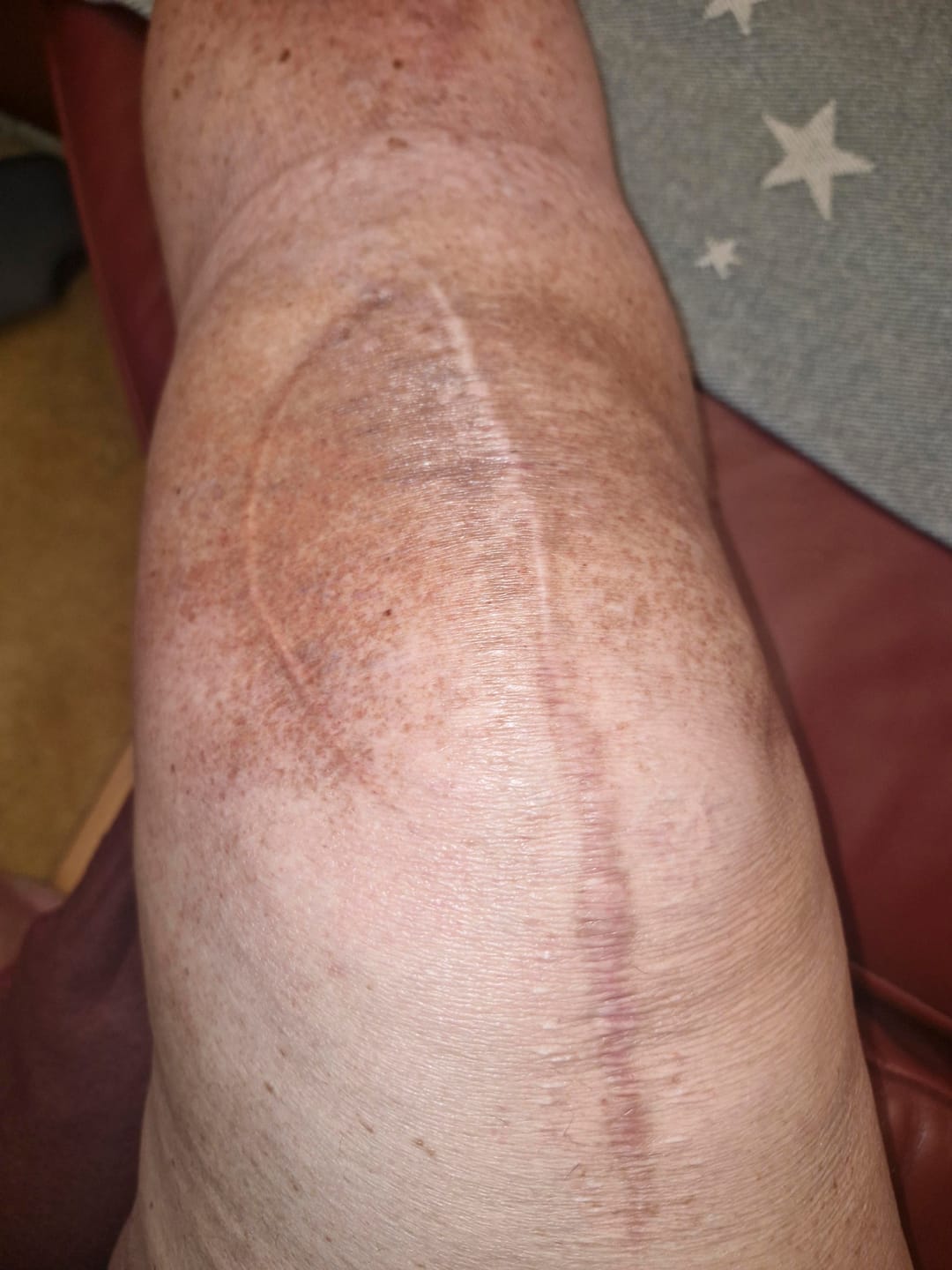 Customer photo review of Duftstofffreie, nicht fettende Anti-Juckreiz-Lotion mit Ceramid NP für trockene, gerötete und empfindliche Haut