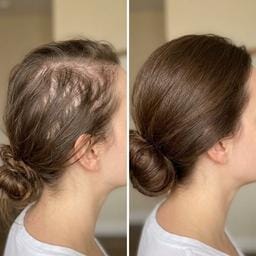 Customer photo review of Serum Anticaída para hombres y mujeres Hair Biolabs™