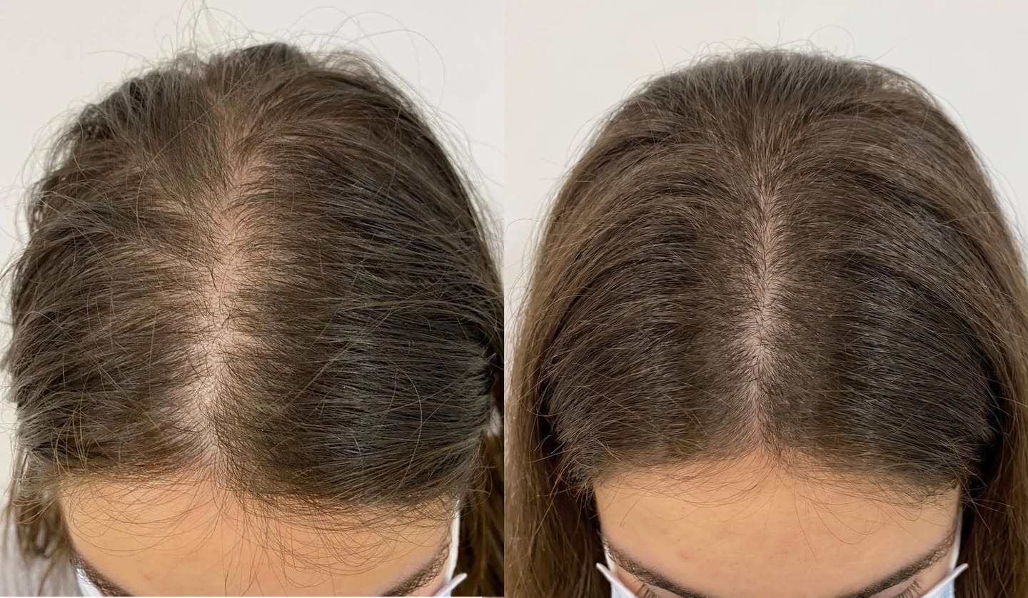 Customer photo review of Serum Anticaída para hombres y mujeres Hair Biolabs™