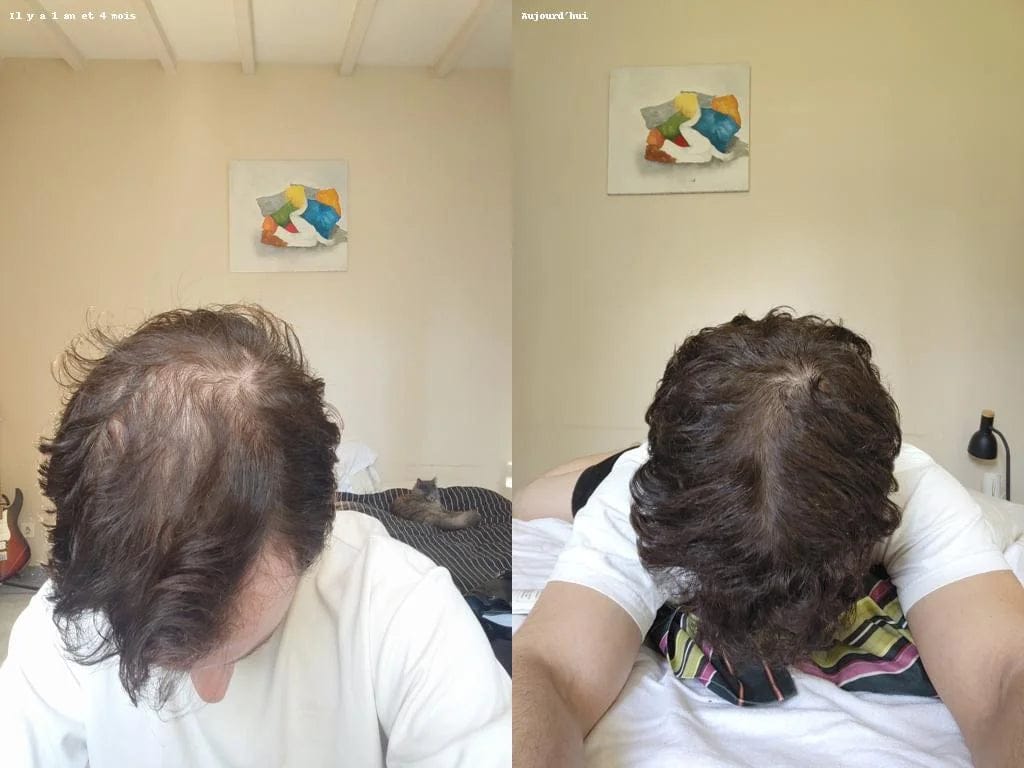 Customer photo review of Serum Anticaída para hombres y mujeres Hair Biolabs™