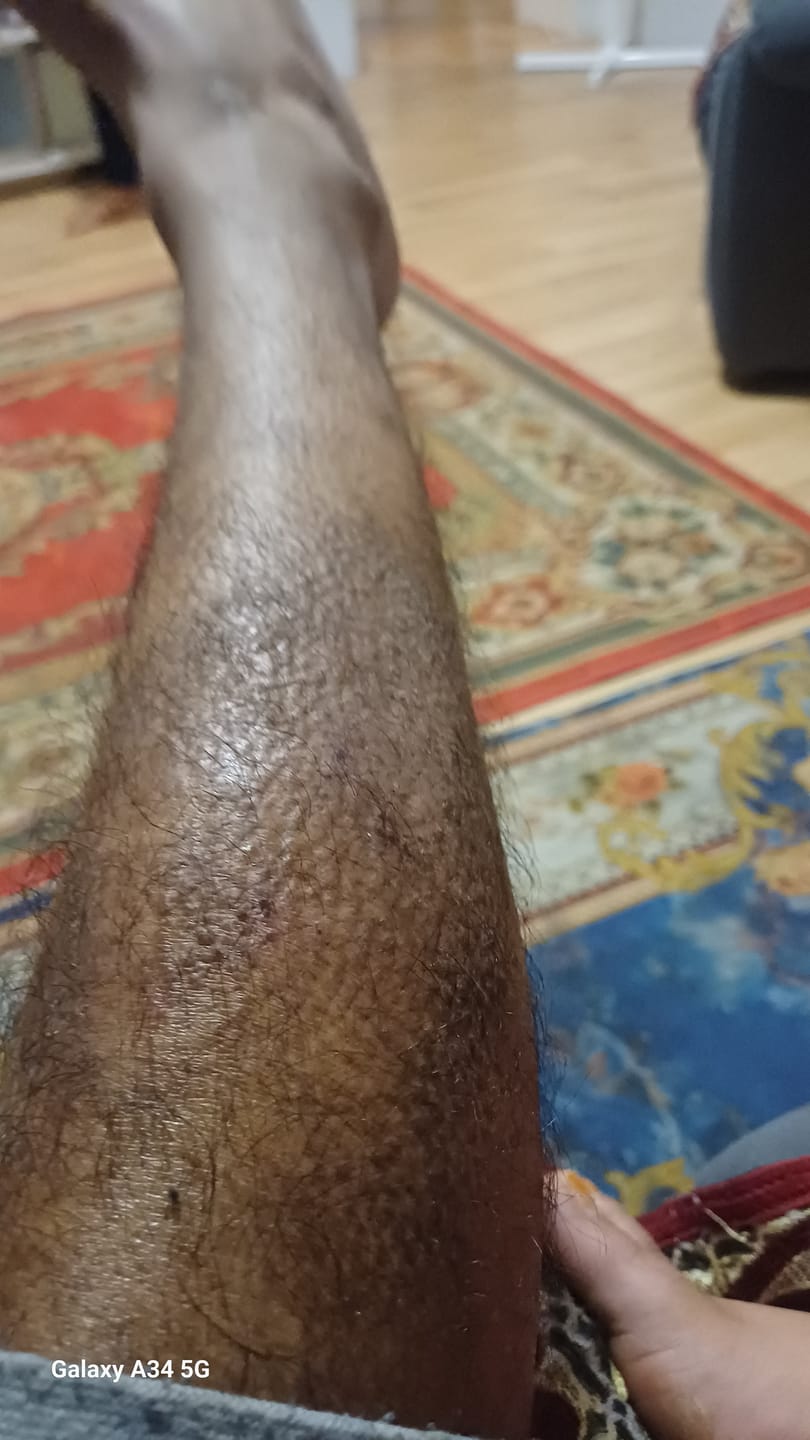 Customer photo review of Smiles & Joys Eczema and Psoriasis Herbal Cream