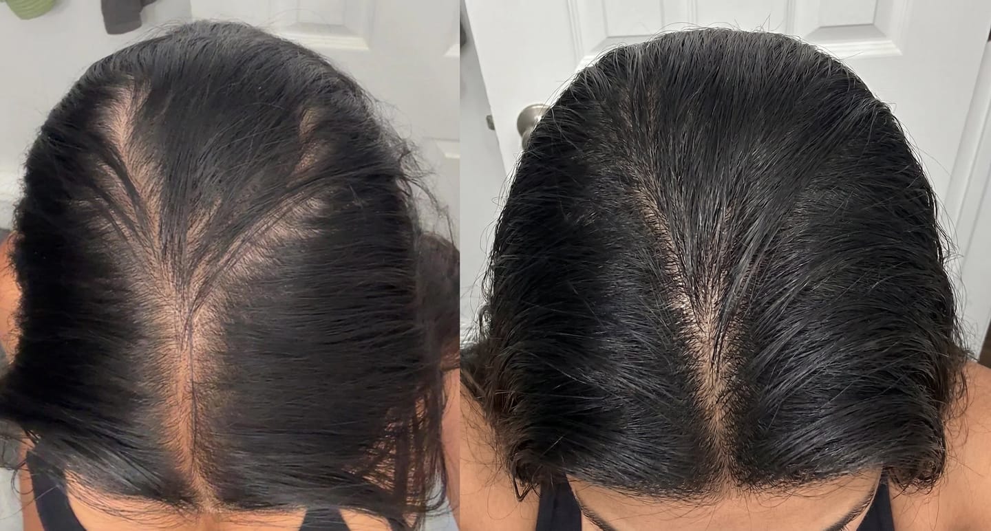 Customer photo review of Serum Anticaída para hombres y mujeres Hair Biolabs™