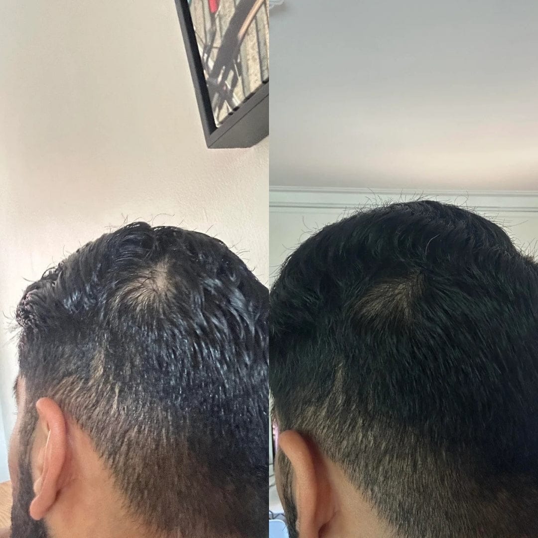 Customer photo review of Serum Anticaída para hombres y mujeres Hair Biolabs™