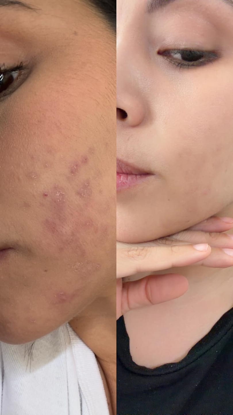 Customer photo review of Azelaic Acid 10 Ampoule