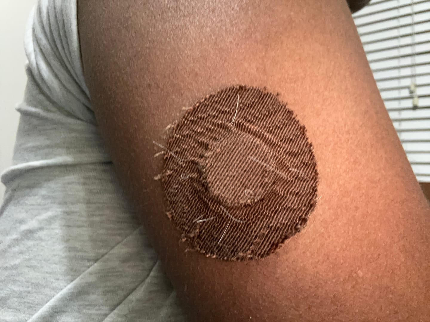 Customer photo review of Skin Grip Original - Libre 3+ Adhesive Patches