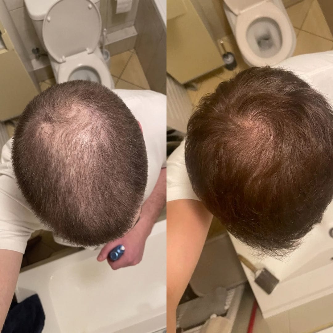 Customer photo review of Serum Anticaída para hombres y mujeres Hair Biolabs™