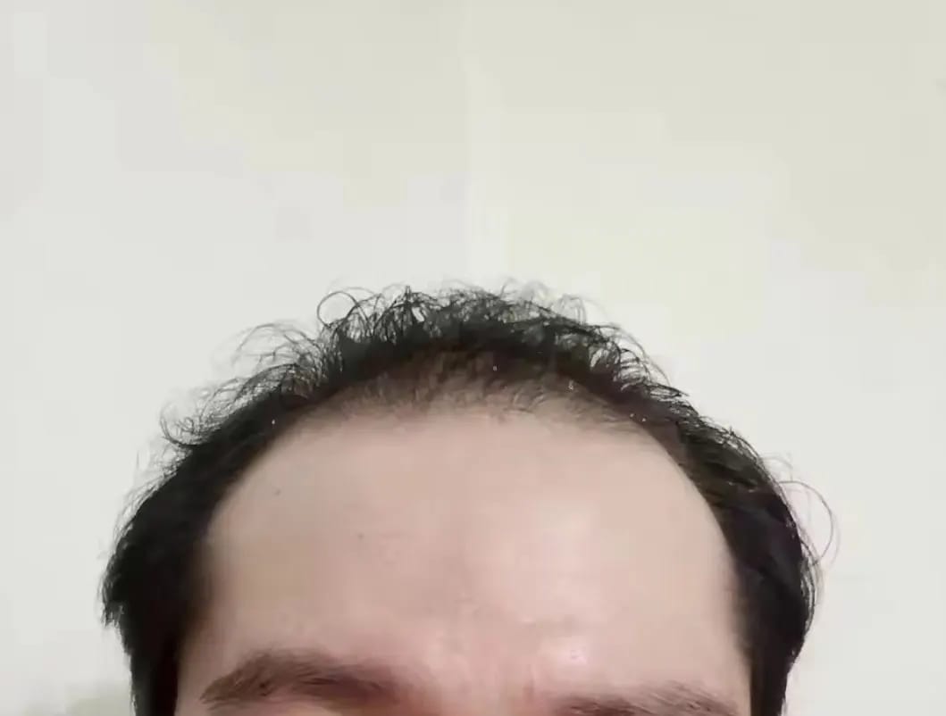 Customer photo review of AQUALYA Korean Hair Serum – Stronger-Looking Hair from the Roots