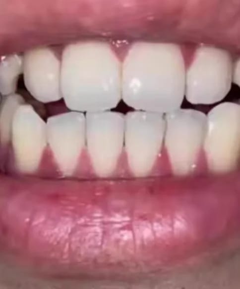 Customer photo review of Teeth Whitener – For a Brighter-Looking Smile