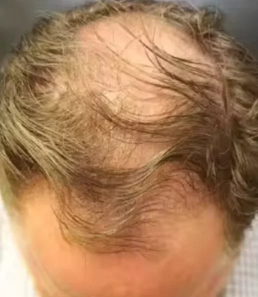 Customer photo review of AQUALYA Korean Hair Serum – Stronger-Looking Hair from the Roots