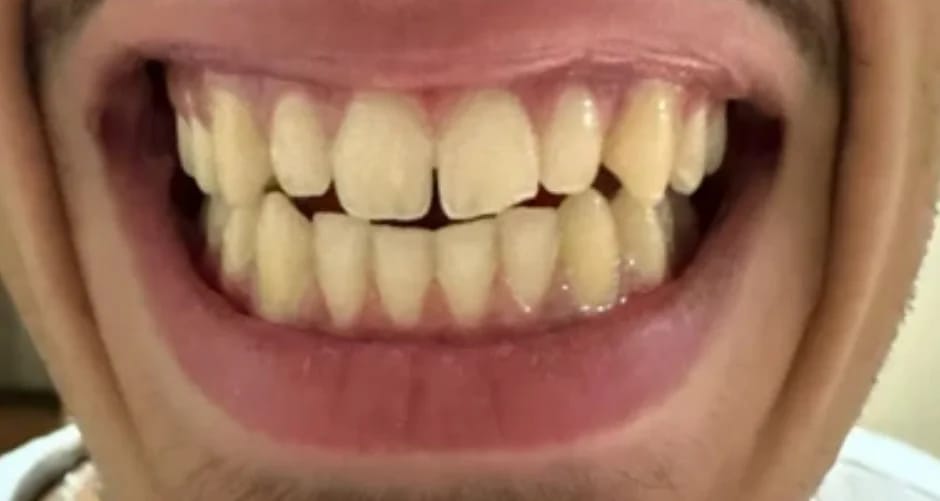 Customer photo review of Teeth Whitener – For a Brighter-Looking Smile