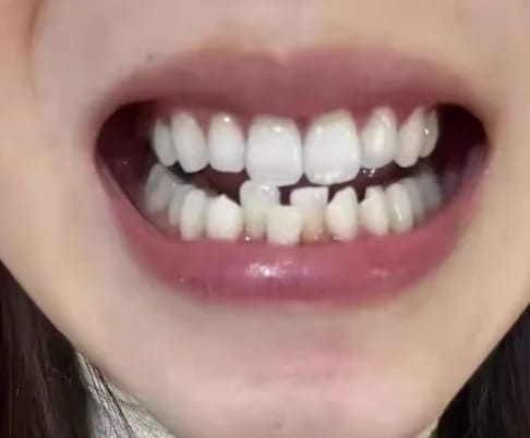 Customer photo review of Teeth Whitener – For a Brighter-Looking Smile