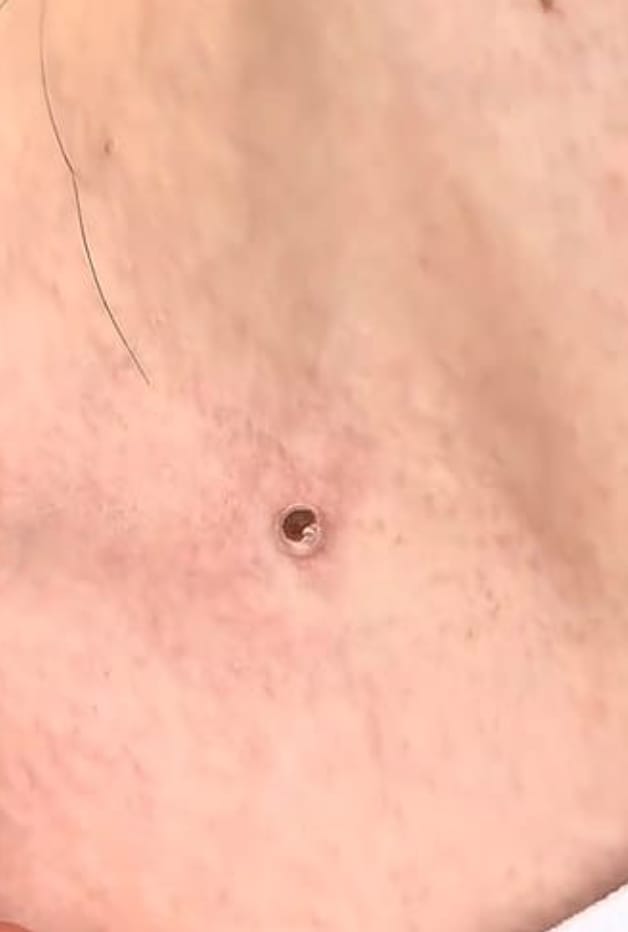 Customer photo review of Painless Skin Tag Removal Kit