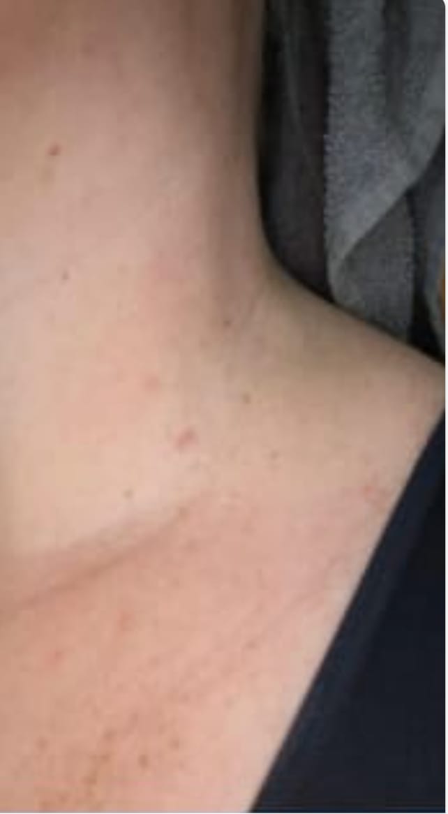 Customer photo review of Painless Skin Tag Removal Kit